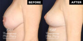 breast lift