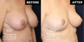 breast lift
