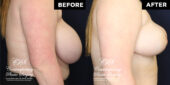 breast reduction