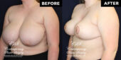 breast reduction