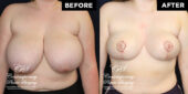 breast reduction
