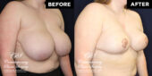 breast reduction
