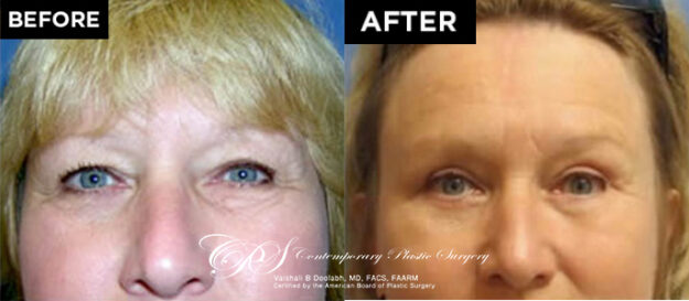 brow lift before after