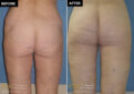 butt lift before and after results