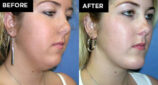 chin augmentation