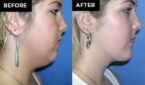 chin augmentation
