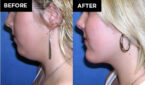chin augmentation