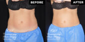 CoolSculpting before after