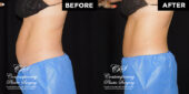 coolsculpting patient before after