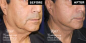 male face lift patient