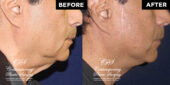 male face lift patient