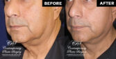 male face lift patient