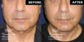 male facelift 10128