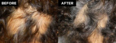 hair restoration patient before and after