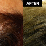 hair restoration patient before and after