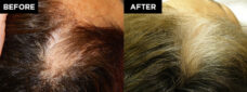 hair restoration patient before and after