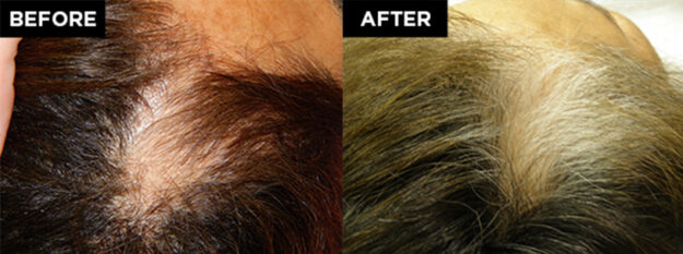 hair restoration patient before and after
