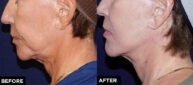 mini facelift and laser treatment before and after