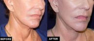 mini facelift and laser treatment before and after