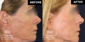 patient before and after skin resurfacing treatment