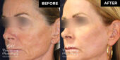 patient before and after skin resurfacing treatment