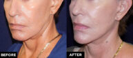 mini facelift and laser treatment before and after
