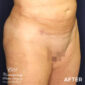After VASER liposuction & Renuvion