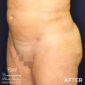 After VASER liposuction & Renuvion