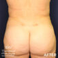 After VASER liposuction & Renuvion