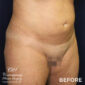 Before VASER liposuction & Renuvion