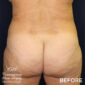 Before VASER liposuction & Renuvion
