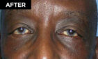 lower eyelid lift patient after