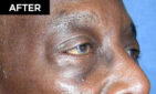 lower eyelid lift patient after