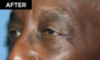 lower eyelid lift patient after
