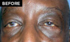 lower eyelid lift patient before