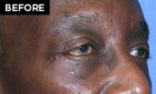 lower eyelid lift patient before