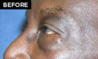 lower eyelid lift patient before