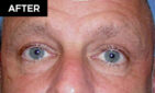lower eyelid lift patient after