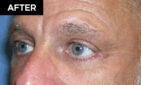 lower eyelid lift patient after