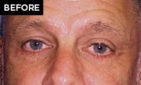 lower eyelid lift patient before