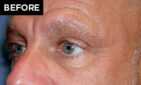 lower eyelid lift patient before