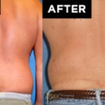 body lift patient before and after