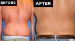 body lift patient before and after