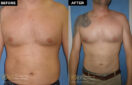 male body contouring before and after