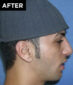 nose surgery patient after