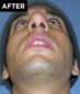 nose surgery patient after