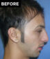 nose surgery patient before