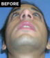 nose surgery patient before