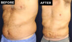 Liposuction and Renuvion before and after
