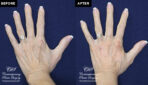 patient results before & after Radiesse injections at Contemporary Plastic Surgery